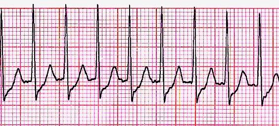 ACLS Tachycardia Narrow Complex Regular | Treatment