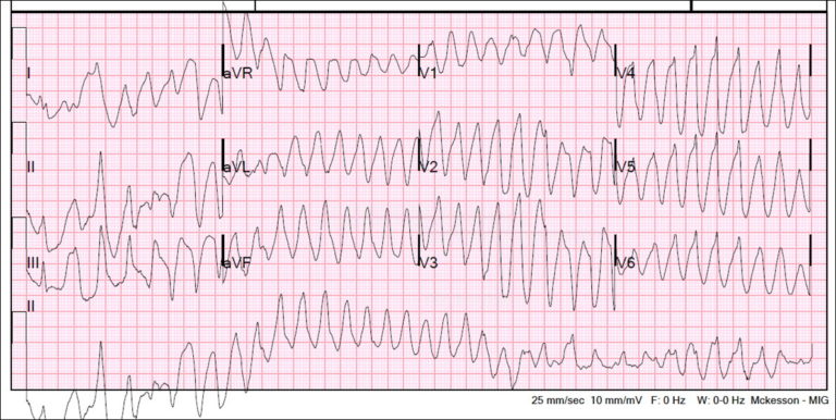 ACLS Tachycardia Wide Complex Ventricular | Treatment